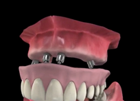 Full Mouth dental implants procedure video