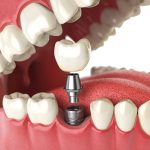 Dental Implant Information For National Safety Month