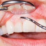LANAP Treats Gum Disease Before It Worsens