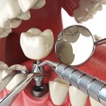 The Low Down on Dental Implants