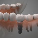 Dental Implant Graphic