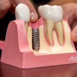 A Dental Implant in Bone Model