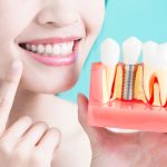 Dental Implant Patient With Dental Implant Model In Hand