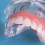 Full Arch Implant Denture Model