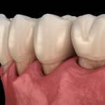 Gum Recession Graphic Close Up