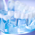 Dentist clear jaw model, dental tooth implant.