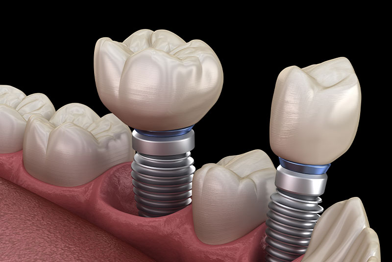 dental implant multiple