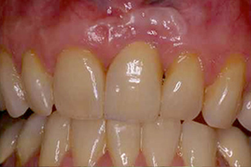 after 7 dental implant
