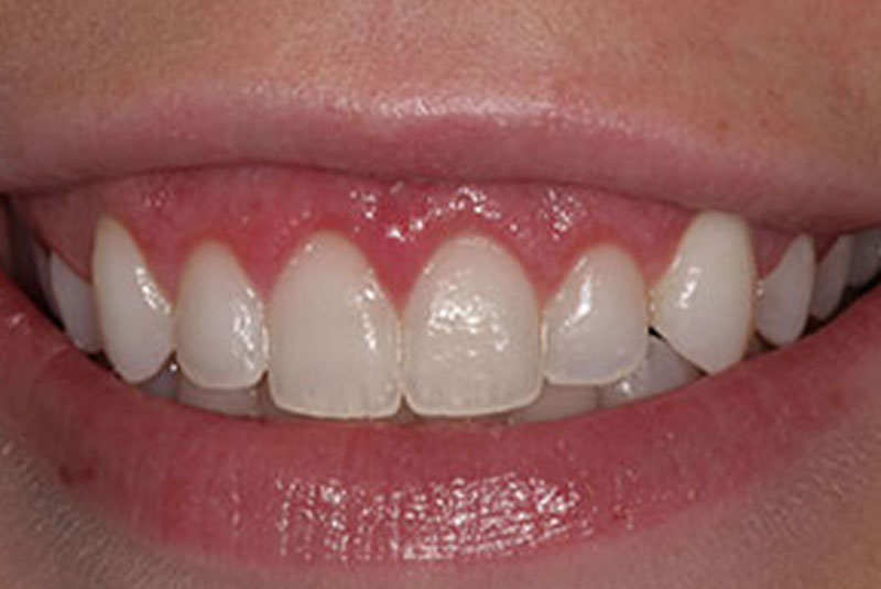 gummy smile after