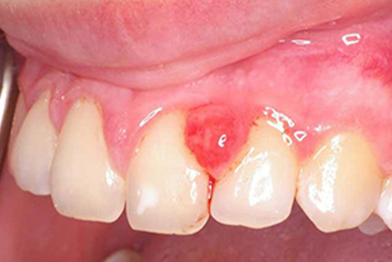 before 1 soft tissue