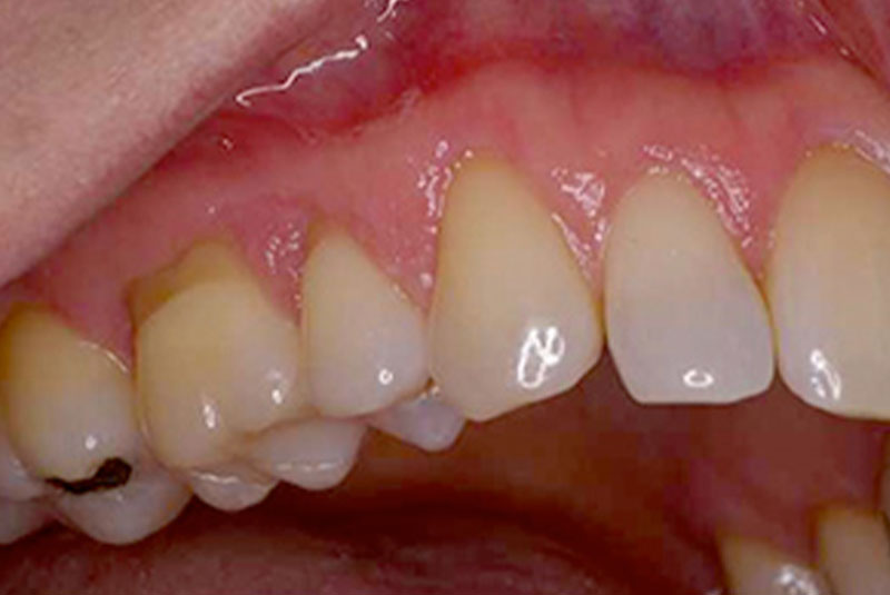 before 4 soft tissue