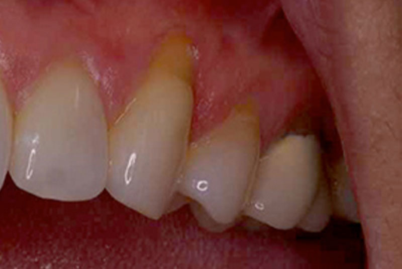 before 5 soft tissue