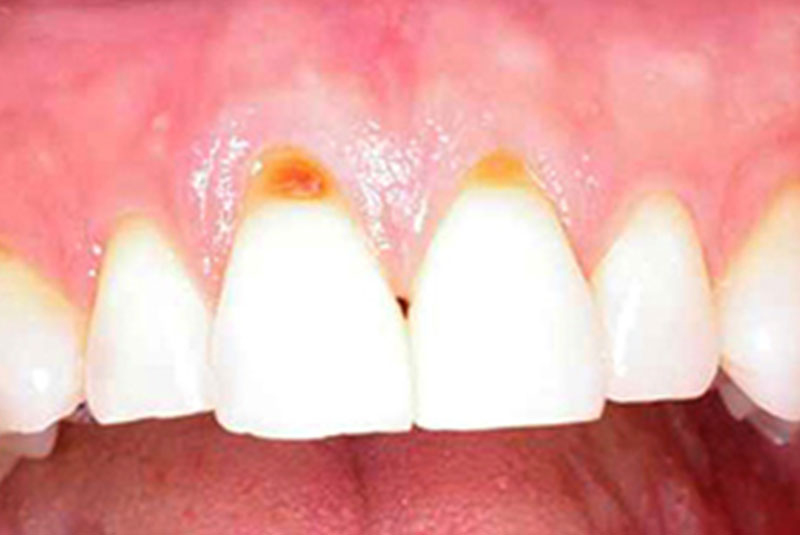 before 6 soft tissue