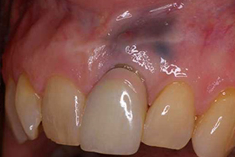 before 7 dental implant