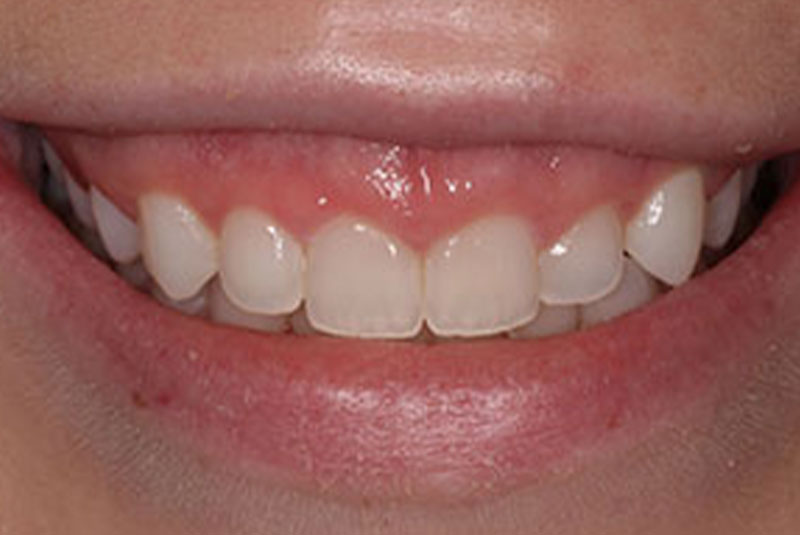 gummy smile before