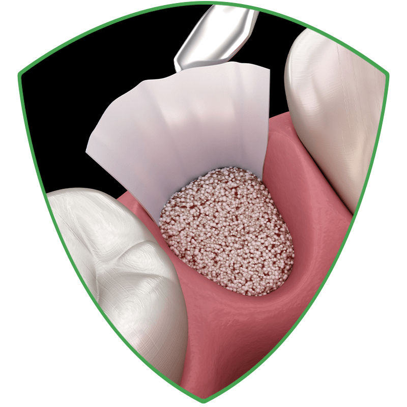 rejuve bone grafting