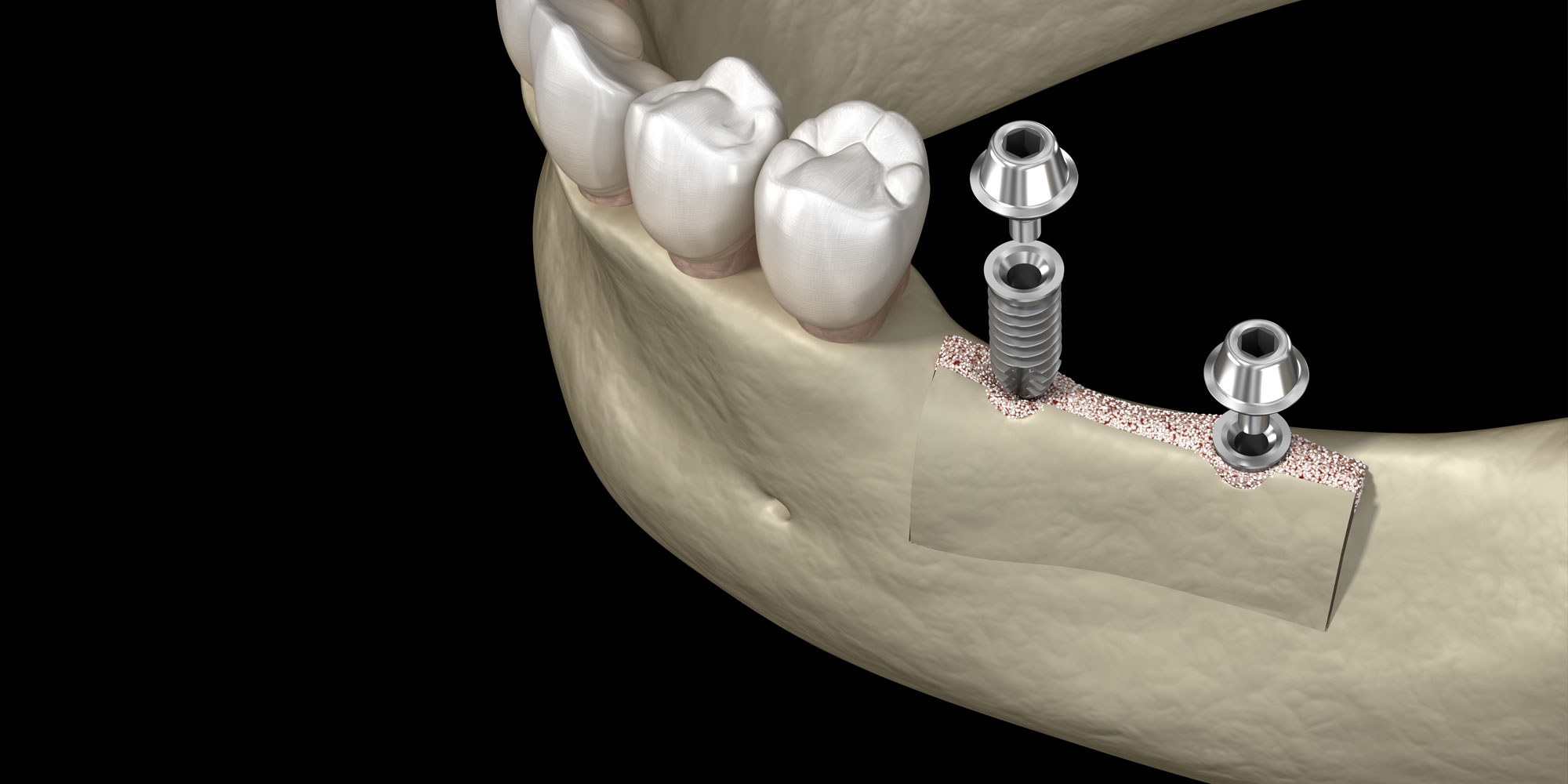 ridge augmentation 3d