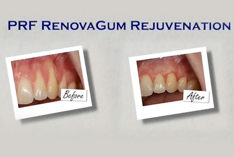 RenovoaGum Rejuvenation
